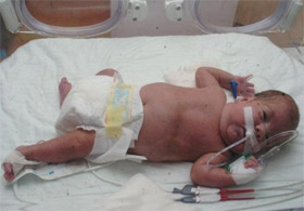 Konyada 23 Haftalık Bebeğe Kalp Ameliyatı Yapıldı